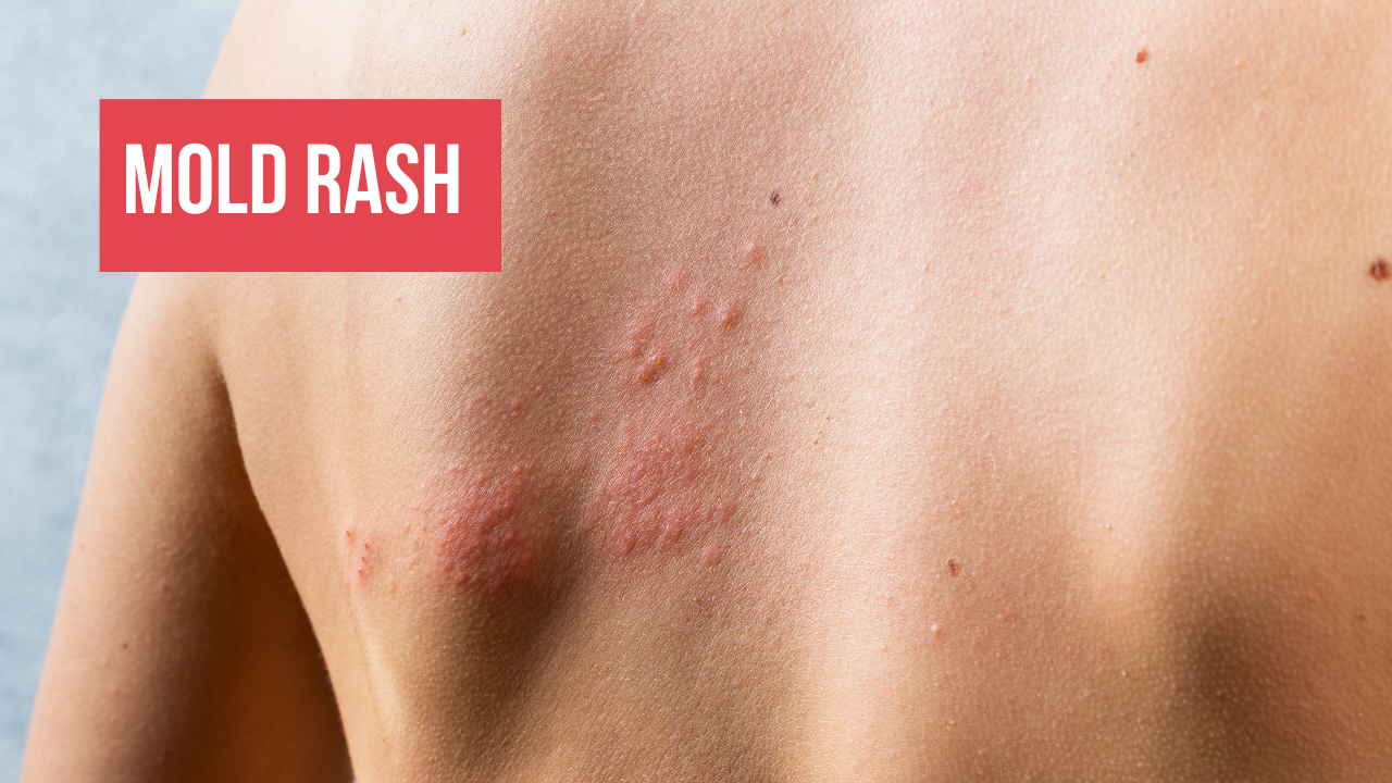 What Is a Mold Rash? – Keep Your Skin Healthy